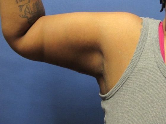 Flexing upper arm with tightened skin