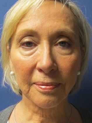 Before photo of a woman seeking Facelift Surgery in Little Rock, AR with the RestoreLift Facelift